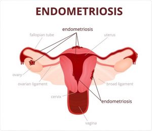 Ciencia | “En la lucha contra la endometriosis, es crucial acabar con los estereotipos asociados a la menstruación”